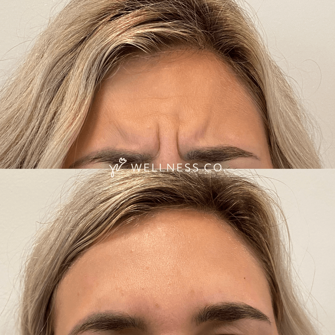 Before and After Photo | frown lines removal by Botox | Wellness Co. | Zeeland, MI
