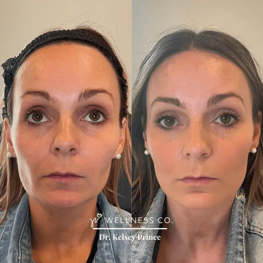 Before and After Photo | Aesthetic treatments | Wellness Co. | Zeeland, MI