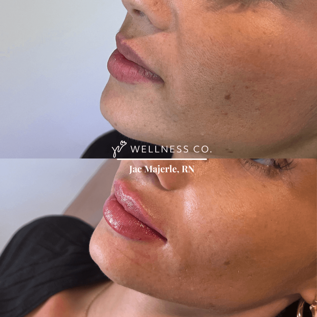 Before and after Photo | Lip Filler woman | Wellness Co. | Zeeland, MI