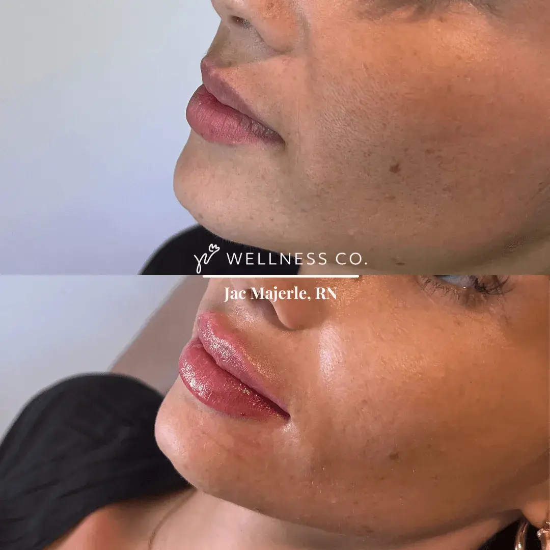 Before and after Photo | Lip Filler woman | Wellness Co. | Zeeland, MI