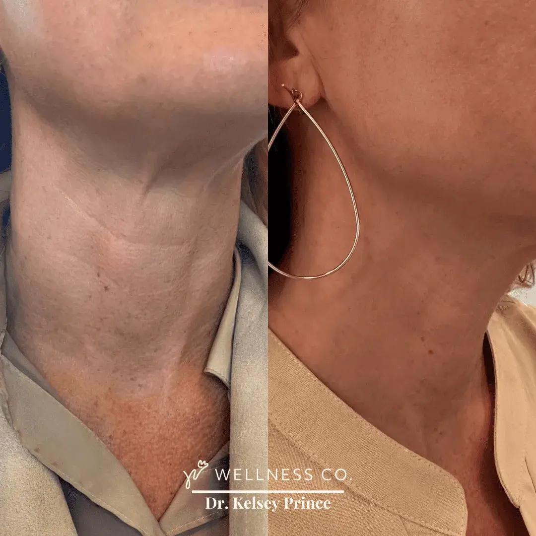 Before and after Photo | Neck wrinkles | Wellness Co. | Zeeland, MI