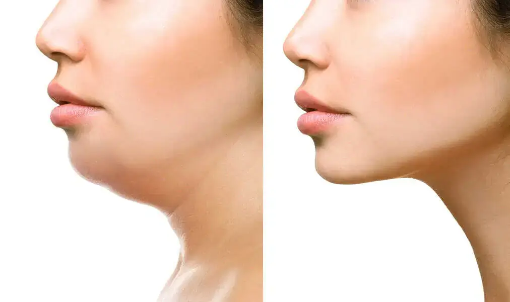 Kybella in Zeeland, MI